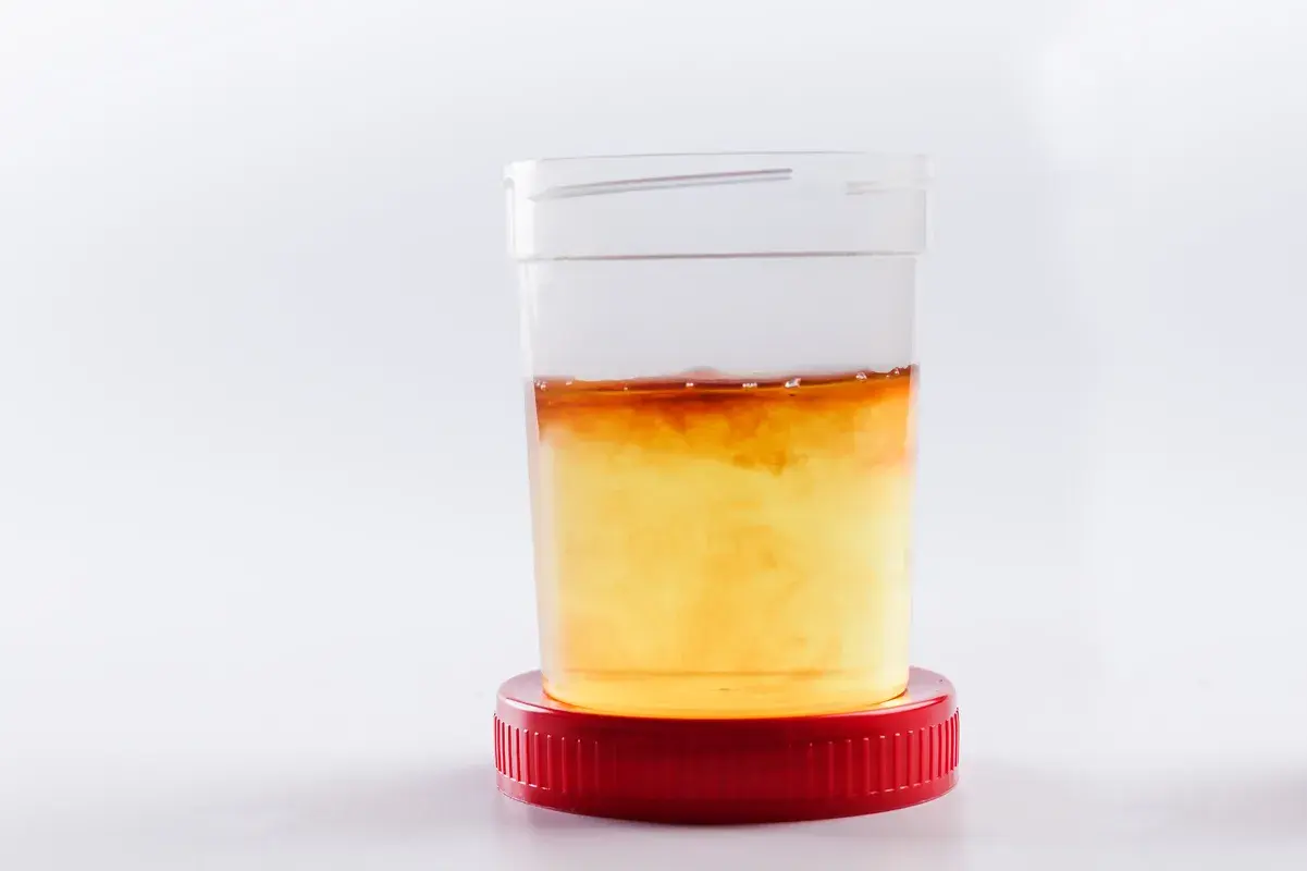 Urine sample container showing hematuria