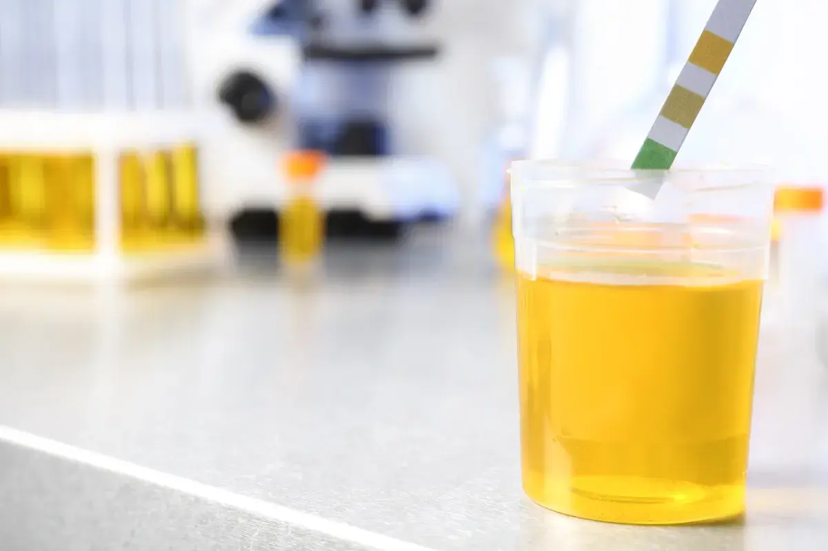 Medical test strip dipping into a yellow urine cup