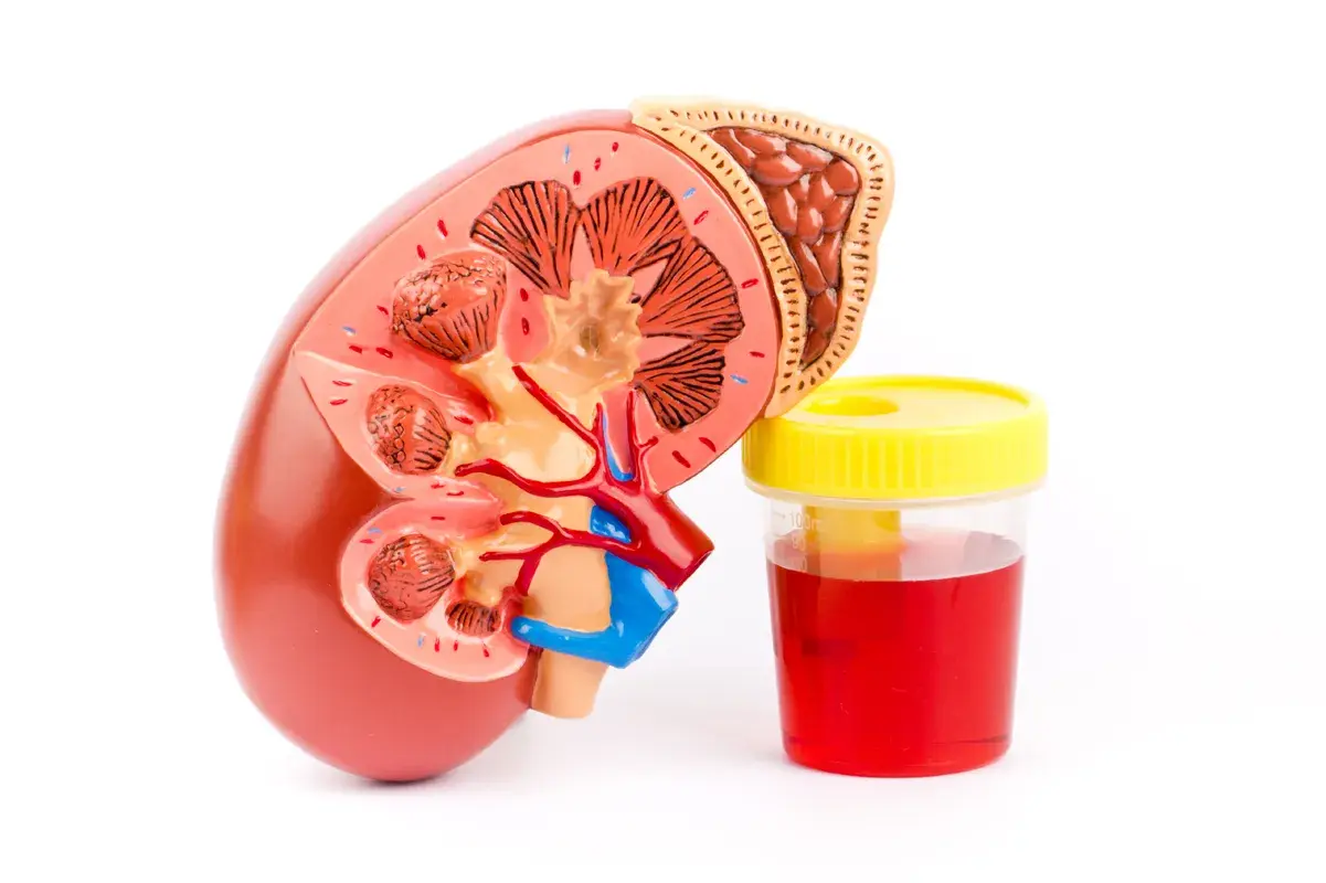 Kidney model with bloody urine test container