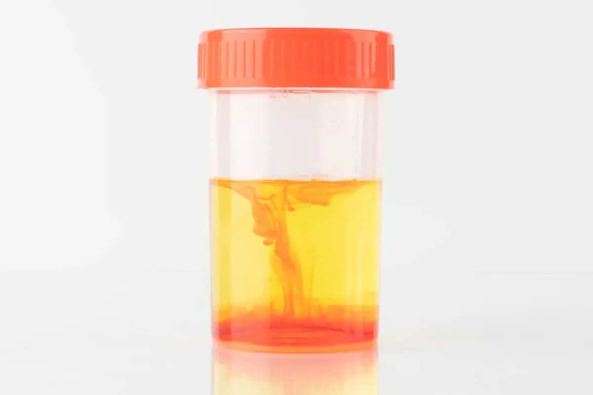 Laboratory sample bottle containing blood in urine