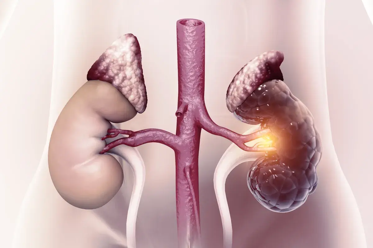 Medical illustration of a healthy kidney and a diseased kidney