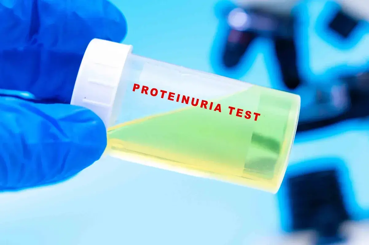 Proteinuria test urine sample container