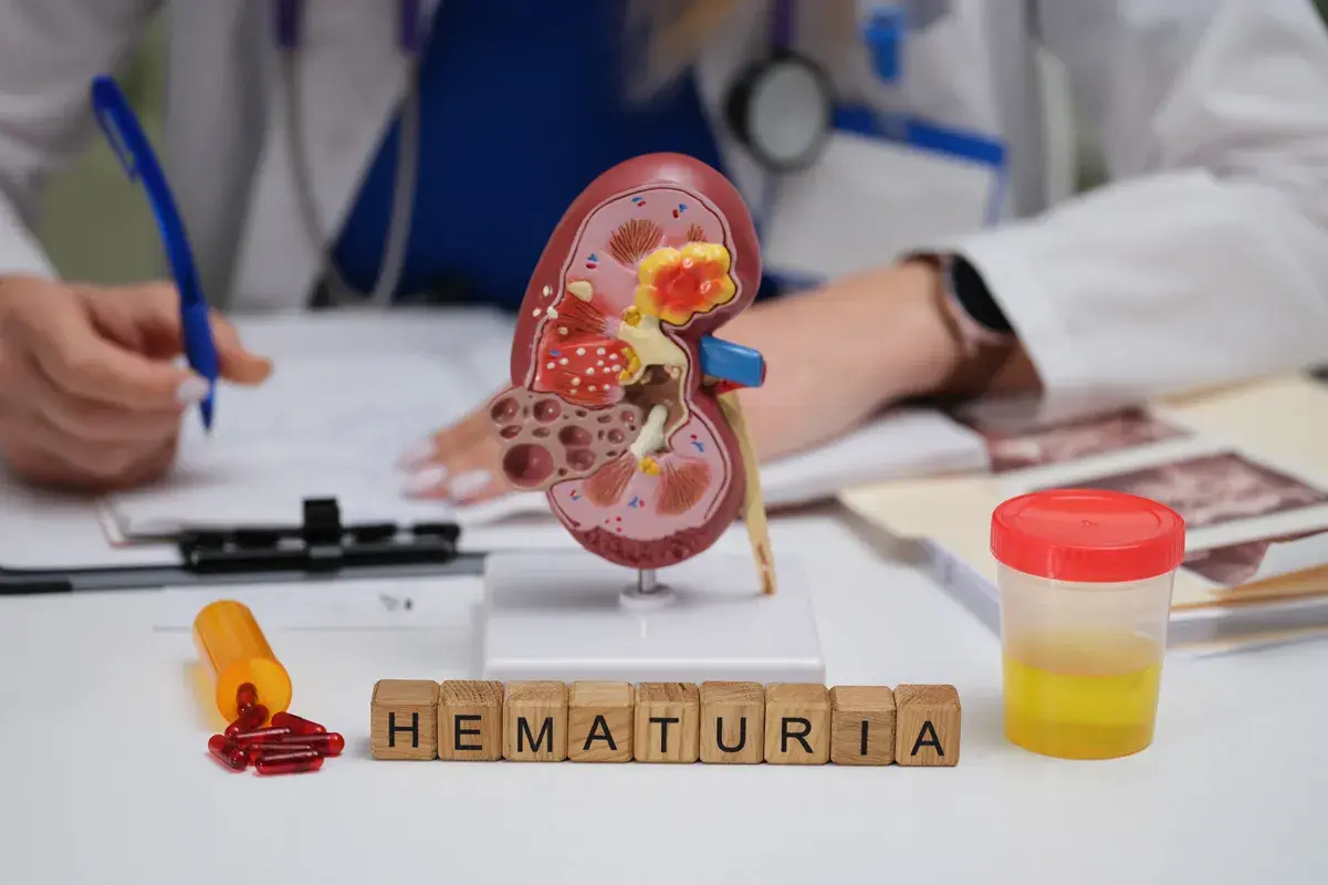 Hematuria sign and kidney model at doctor's desk