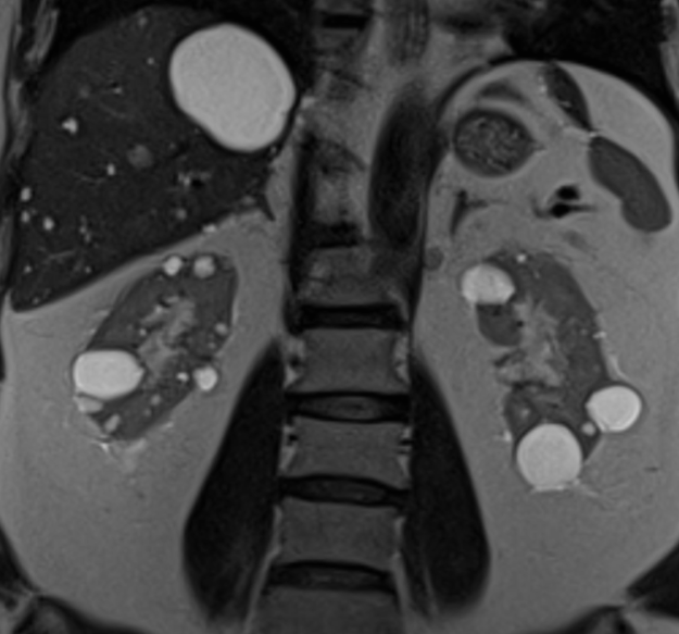 Kidney cysts (cystic kidney disease) image