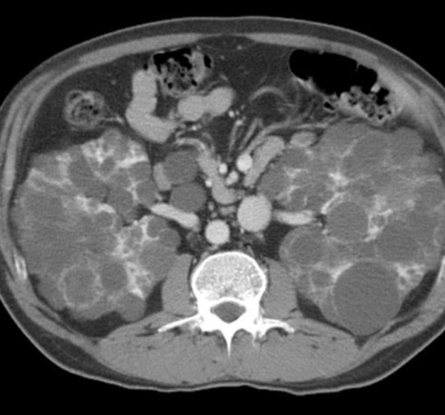 Types of cystic kidney disease
