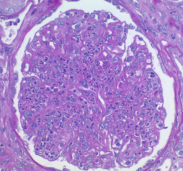 Symptoms of diabetic kidney disease (DKD)