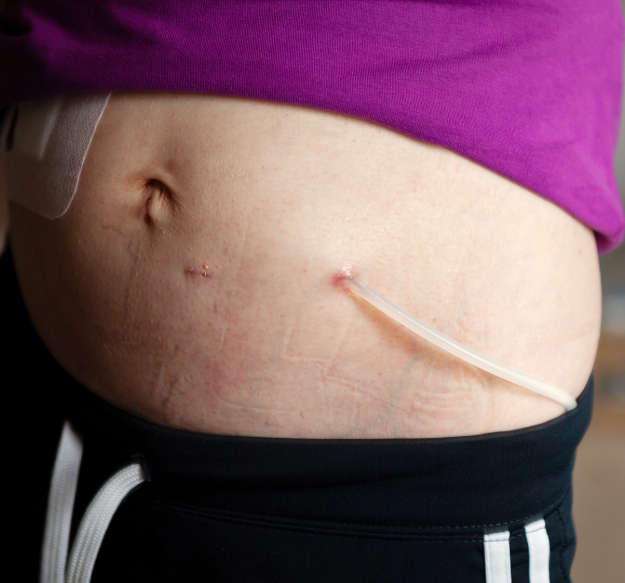 Patient on peritoneal dialysis