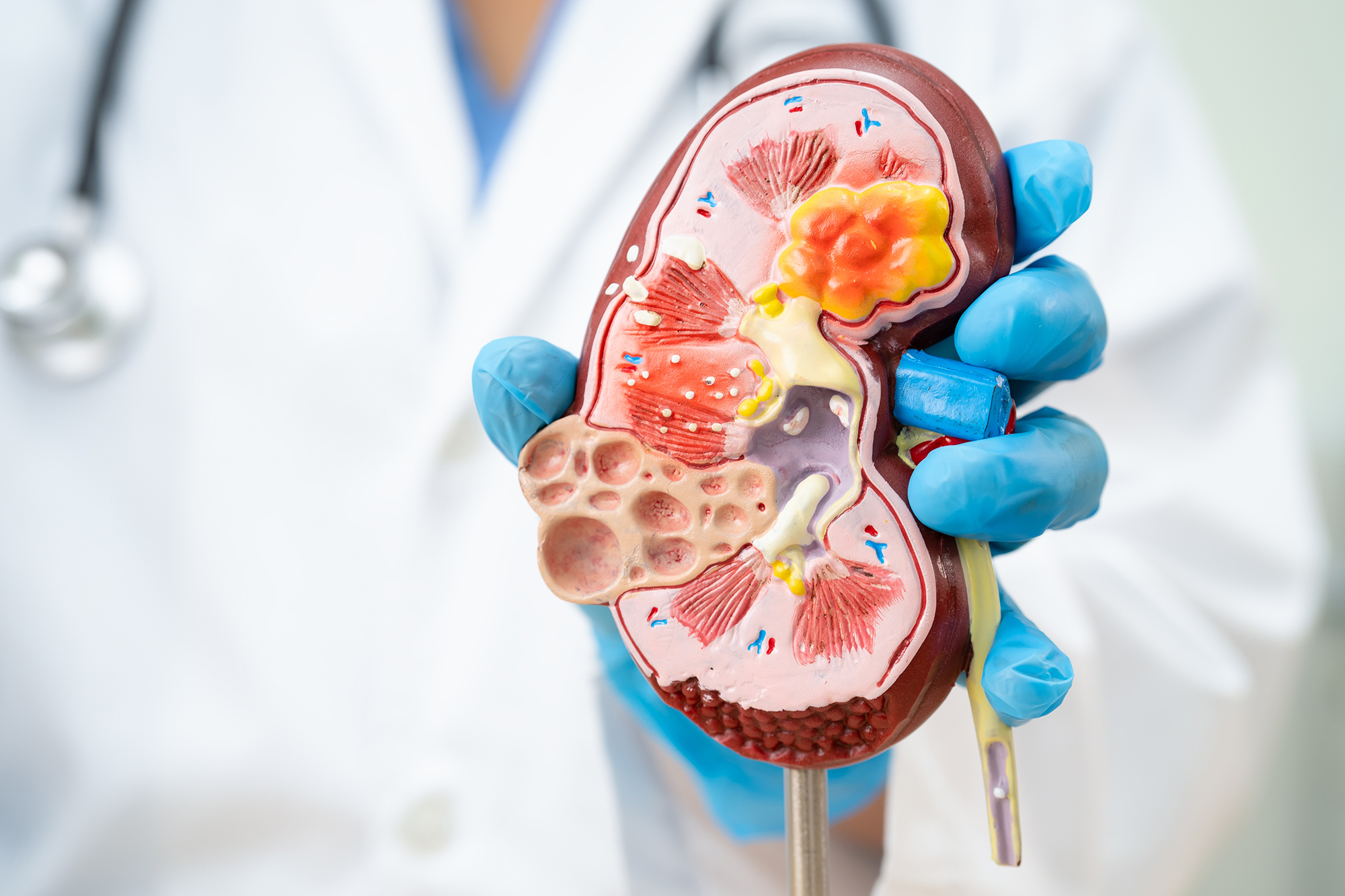 What Are the Stages of Diabetic Kidney Disease?